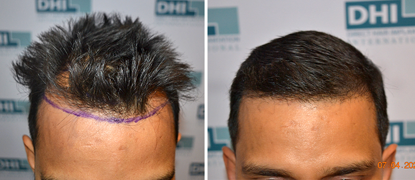 DHI before & after hair transplant results